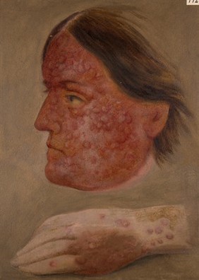 Face and hand of a woman affected with erythema tuberculatum