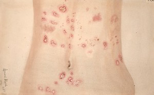 view Dermatitis herpetiformis on the abdomen of a woman