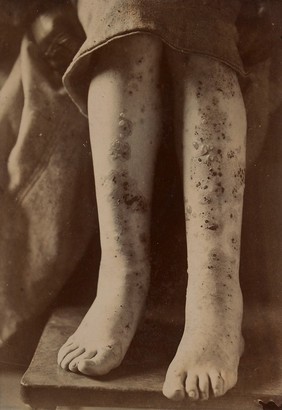 Legs from a case of dermatitis herpetiformis