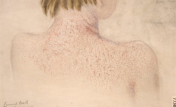 Neck and shoulders of a girl suffering from pityriasis rubra pilaris