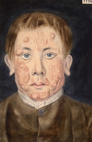 view Chronic skin disease of an uncertain nature