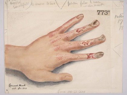 Hand with Roentgen ray dermatitis