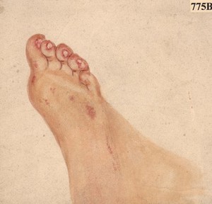 view Foot of a girl with a peculiar ulcerative affection of the skin