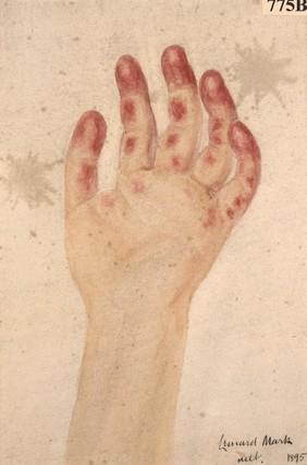 Hand of a girl with a peculiar ulcerative affection of the skin