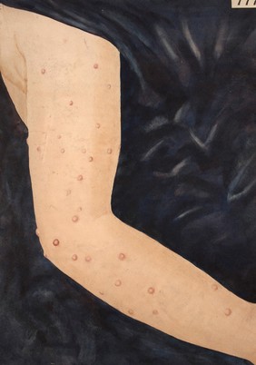 Arm with urticaria pigmentosa