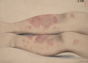 view Probable case of urticaria haemorrhagica on the legs