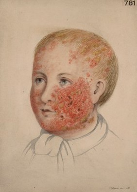 Eczema of the cheek and scalp of a child