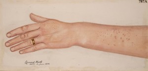 view Darier's disease affecting the arm