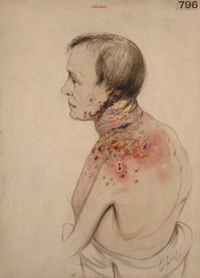 Herpes zoster of the neck and shoulder