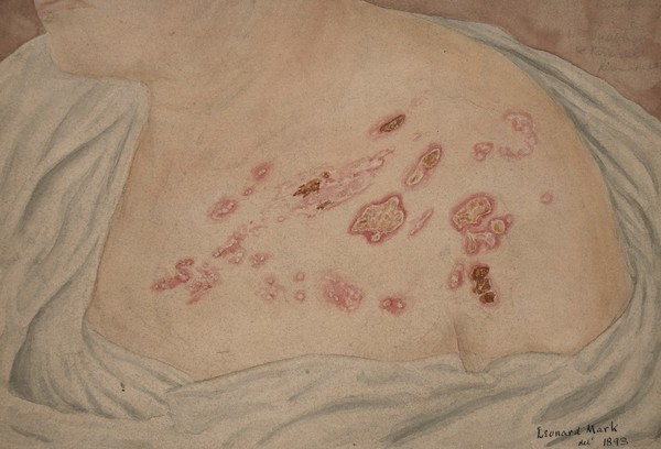 Upper chest and shoulder of a woman with skin eruption due to herpes zoster