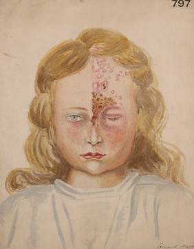 Face of a girl with herpes frontalis