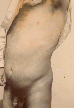 view Flank of a man with a ringworm infection