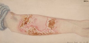 view Pustular eruption on the forearm from a case of pemphigus