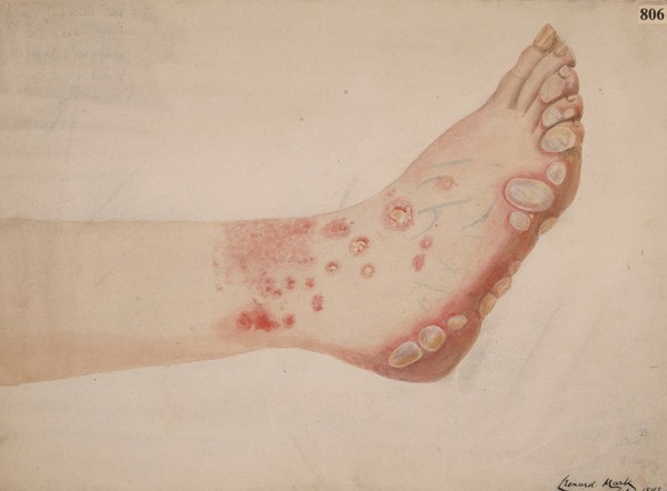 Bullous eruption on the foot of a woman