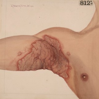 Right axilla showing the later stages of pemphigus vegetans