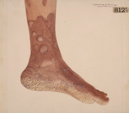 Foot showing the later stages of pemphigus vegetans