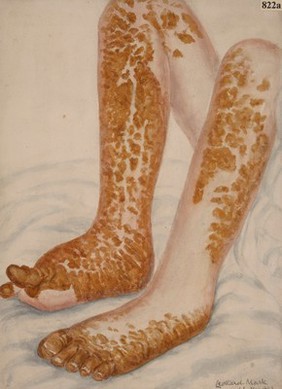 Legs of a woman with a marked ichthyotic condition of the skin