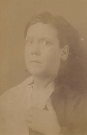 view Face and neck of a girl with cutaneous horn