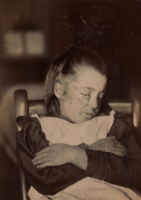 Girl with Kaposi's disease