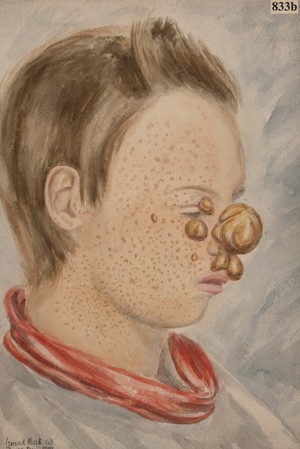 view Girl with Kaposi's disease