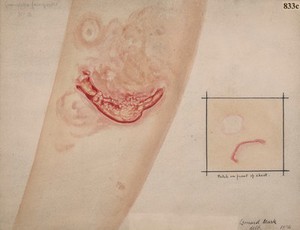 view Granuloma fungoides on the skin of the leg and chest