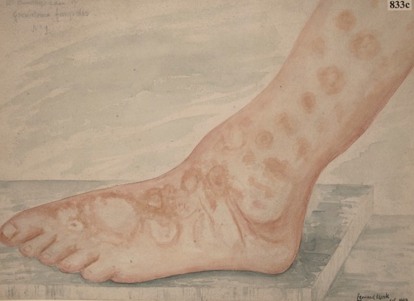 Granuloma fungoides on the skin of the foot