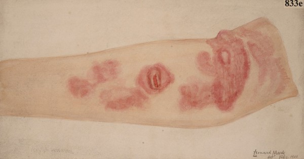 Arm of a woman suffering from mycosis fungoides of the skin