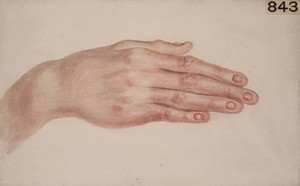 view Hand of a boy with congenital absence of nails