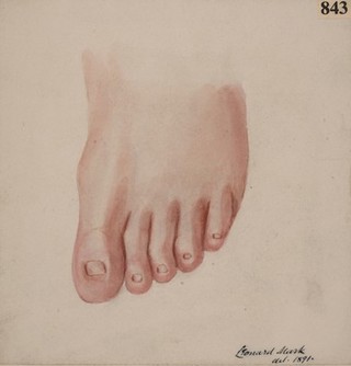 Toes of a boy with congenital absence of nails
