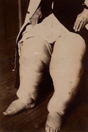 'Elephantiasis' of the legs. Photograph, 1895.