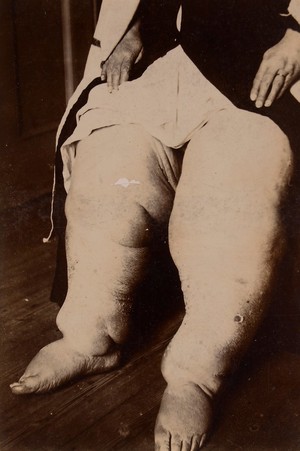 view 'Elephantiasis' of the legs. Photograph, 1895.