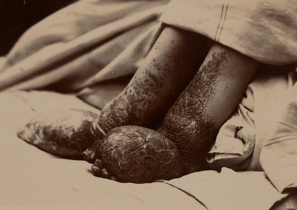 'Elephantiasis' of the legs of a woman