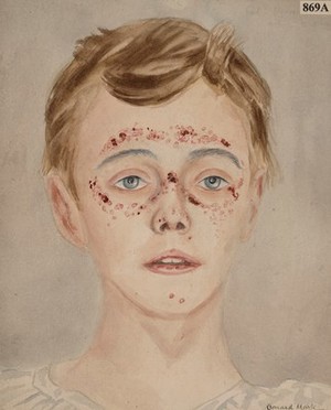 view Face of a boy with a symmetrical eruption, possibly purpuric in nature