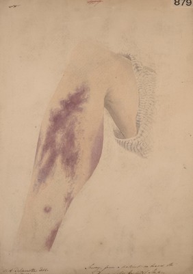 Leg from a patient suffering from scurvy