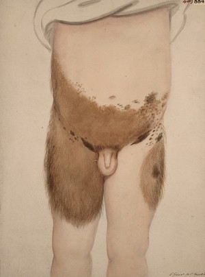 view Congenital hairy mole affecting the lower stomach and thighs of a boy