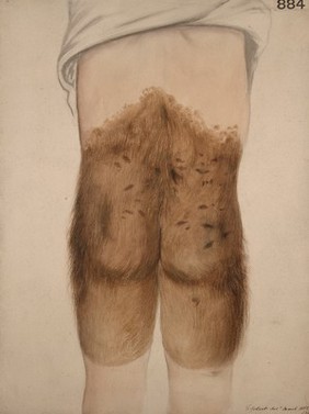 Congenital hairy mole affecting the lower back, buttocks and thighs of a boy
