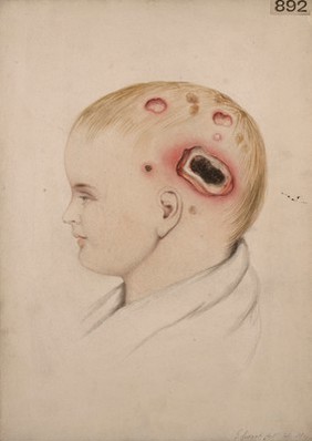 Head of a child with varicella gangrenosa