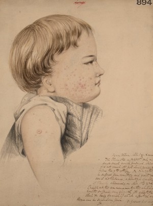 view Eruption on the skin appearing nine or ten days after vaccination