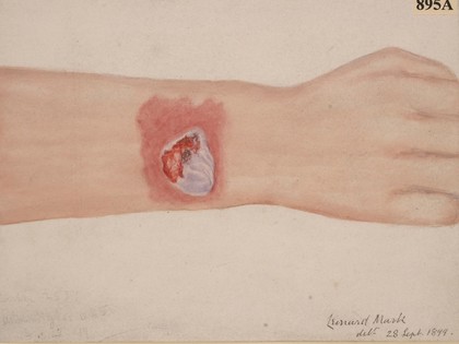 Ulcer on the wrist probably due to cowpox