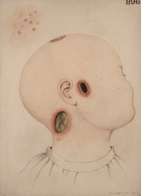 Head of a child with varicella gangrenosa