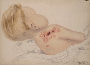 view Child with an eruption of an echthymatous nature on the right shoulder