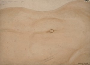 view Abdomen of a youth with taches bleuatres due to typhoid fever