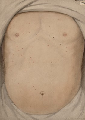 Chest and abdomen of a patient with unusually copious typhoid eruptions