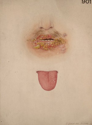 view Lips and tongue of a man affected with pustular herpetic eruptions