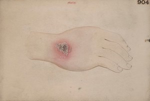 view Pustular eruption on the hand of a man suffering from glanders