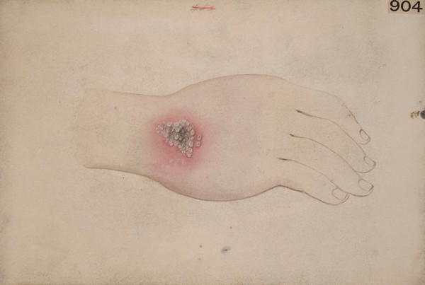 Pustular eruption on the hand of a man suffering from glanders