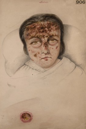 Eruption of the face of a young woman who worked making seal skin purses