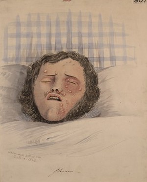 view Face of a man with a bloody discharge from the nose and pustules on his skin probably due to glanders