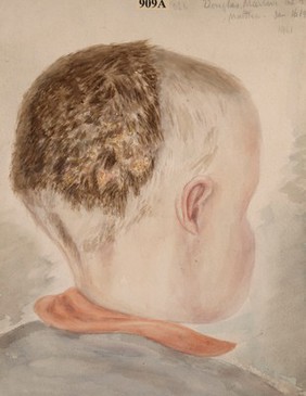 Head of a boy suffering from favus