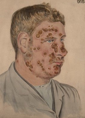 Face of a man covered in a rash due to iodide of potassium